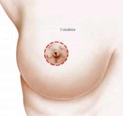 Tuberous Breast Surgery by Dr. Benelli in Paris